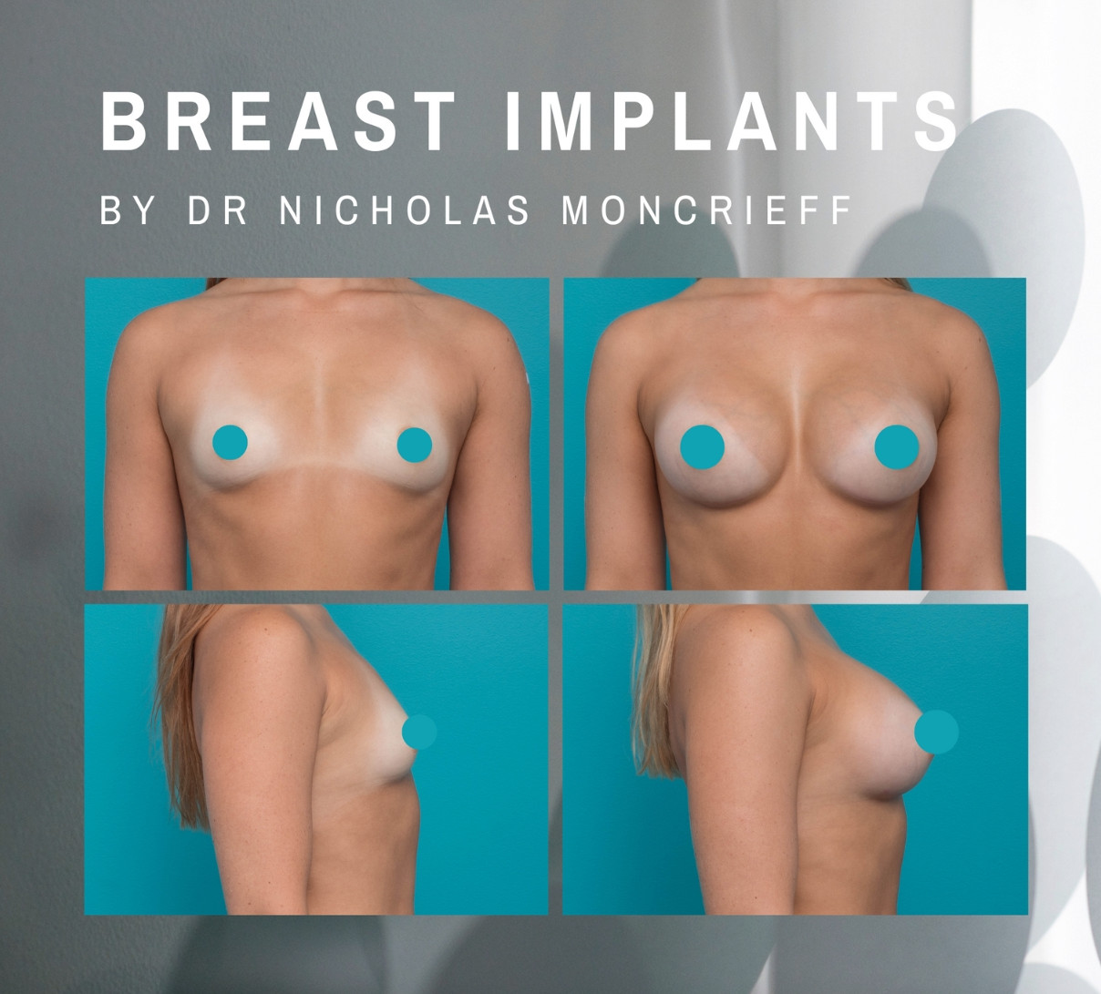 Breast Augmentation Newcastle Hunter Plastic Surgery